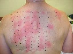 Allergy testing in Northfield MN